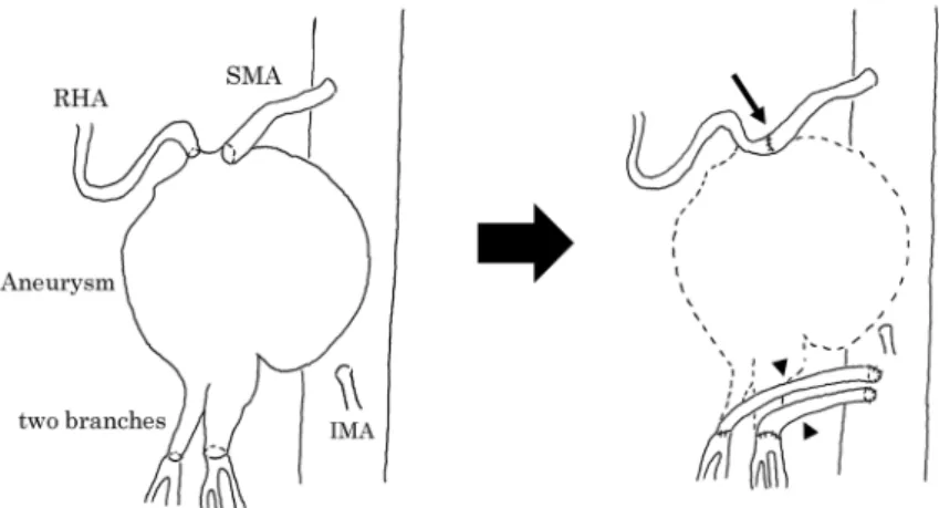 Fig. 4  Enhanced three-dimensional computed tomography image  (arrow; blood vessel graft, arrowhead; SMA-RHA bypass).