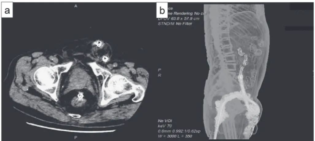 Fig. 1　Abdominal CT.  a: The left inguinal hernia was incarcerated, the hernia sac contents including the sig-moid colon with the endoscope inserted in it. There was no apparent ascites or free air