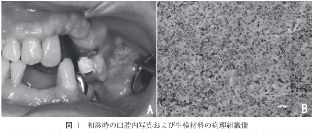 図 2　治療前の各種画像所見 造影 CT 所見： 左側頰部の腫瘤（矢印）の位置に一致した造影効果を伴う領域が認められる（A）。また，左側顎下部に rim enhancement を伴う腫大したリンパ節が認められる（B）。 MRI 所見： 左側頰粘膜の腫瘤（矢印）に一致して，T1 強調像では低信号（C），T2 強調像では中間信号（D）を呈する 領域が認められ，同領域は造影 MRI で造影効果が認められる（E）。また，腫瘤は左側上顎洞底部にも及ん でおり，上顎洞底部への骨浸潤が疑われた。 PET-CT 所見： 