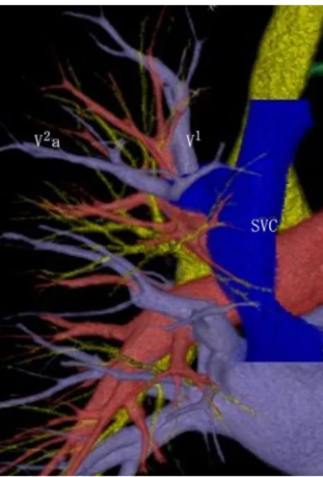Fig. 1a   Chest CT showing a 3.1 cm part-solid nodule in  the left lung S 1＋2 .
