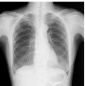 Fig. 1 Chest  radiograph  in  August  2019  showed  a  nodule  in  the  right  middle  lung field.