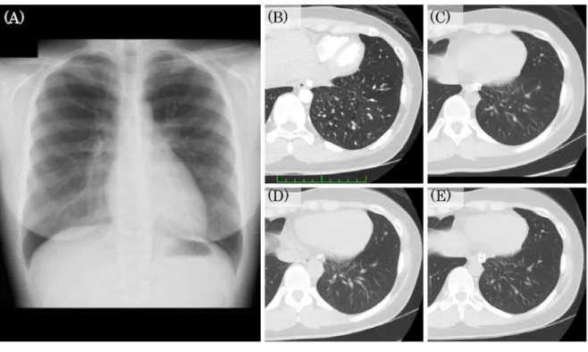 Fig. 1  (A) Chest radiograph suggested no obvious abnormalities  (B) Chest enhanced computed tomography (CT) showed a normal parenchymal density   (C) Six months post-embolization, CT showed no evidence of pulmonary infarction or increased parenchymal den-