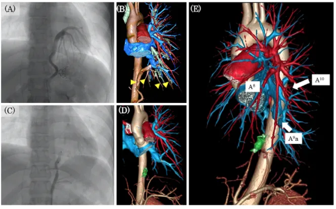 Fig. 2  (A) Selective angiography of the aberrant artery originating from the celiac artery and feeding the basal area of  the left lower lobe   (B) 3D-CT shows an aberrant artery (yellow arrowhead) branching from the celiac artery distributed to the nor-m