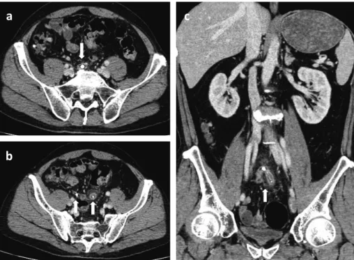 Fig. 1　Although an abdominal enhanced CT scan revealed swelling of the appendix, which had  three fecal stones, intra-abdominal abscess and ascites were not detected (white arrows)