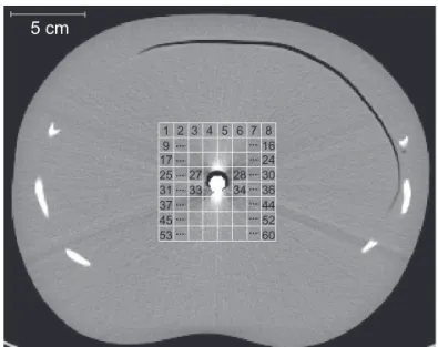 Fig. 3 CT image of anthropomorphic abdominal phantom with an iron rod inserted into the cavity.
