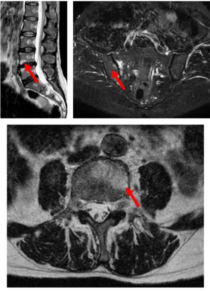 図 3 　腰椎・仙腸関節部造影 MRI（第 4 病日） 腰椎 L2 ～ 5（矢印）で STIR にて高信号を認め，造影で同部位の髄内ま で増強効果あり．また仙骨右側・右腸骨（矢印）にも同様の所見を認める． 以上から仙腸関節炎，慢性再発性多巣性骨髄炎と診断． 図 4 　骨シンチグラフィ 左足関節，両側手指関節（矢印）に RI 集積亢進を認める．胸骨・胸鎖関節に明らかな異常集積を認めず．図2　右手関節造影MRI（第2病日）右手根関節（矢印）に腱鞘炎，骨びらんの所見を認める．