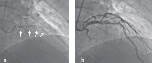 Fig. 3　IVUS images of the LMT (A), LAD just proximal to the  lesion (B), and lesion in segment 6 (C)