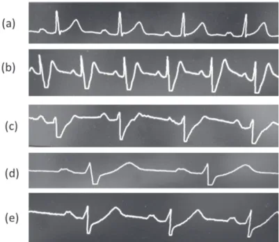 Fig. 5　Changes over time in ECG lead II monitor waveforms during  PCI. (a) Start of PCI; (b), (c), (d) between LMT occlusion and the  in-jection of arterial blood, tachycardia develops, ST-T fl uctuates, and  heart rate gradually slows down; (e) during art