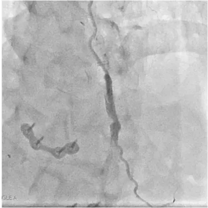 Fig. 7　Postoperative coronary angiography (CRA ＋ LAO).