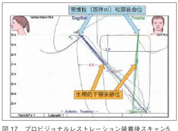 図  16  術前とプロビジョナルレストレーション装着時の顔 貌写真 審美的に良好な状態が獲得できている．位での順応状況などを3 カ月程度観察した．咀嚼運動などの機能的にも問題なく，主訴である審美障害も改善しているため，最終補綴物作製へと移る（図16，17）．③Phase2 修復治療機能的・審美的に安定している現状をできるだけ変化させないように，慎重に修復処置を行う（図18，19） ．主訴である審美障害も改善し良好である（図11，20）．最終補綴物装着後，再度K7にて確認を行う．是正され 図  17  プロ