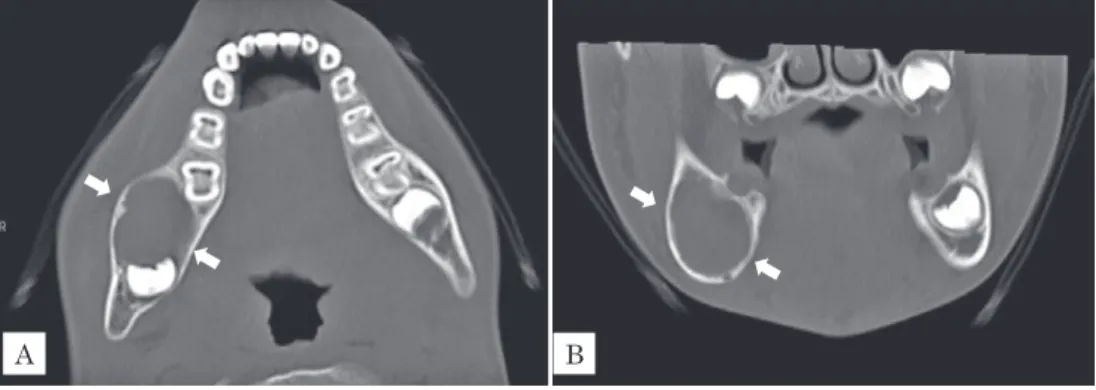 Fig. 3　Computed tomography of the mandible 9 months after the ﬁrst surgery A, B, C：New bone is generated.