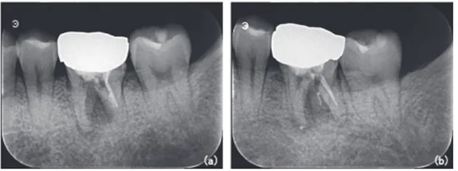 Fig.　₂　 Pre‒treatment X‒ray of the mandibular left first molar. CBCT coronal  sectional image