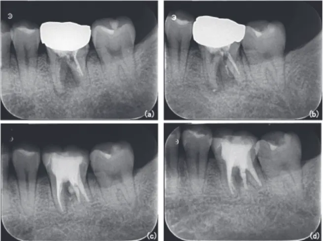 Fig.　₆　 Post‒treatment X‒rays taken three months  after root canal filling of the mandibular  left first premolar