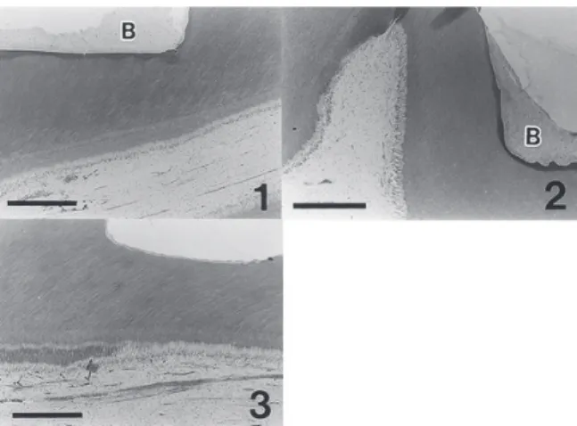 Fig.　₅　 Histological images of dentin‒pulp com- com-plex after restoring by resin composites  with self‒etching bonding system without  cement lining ₁₇）