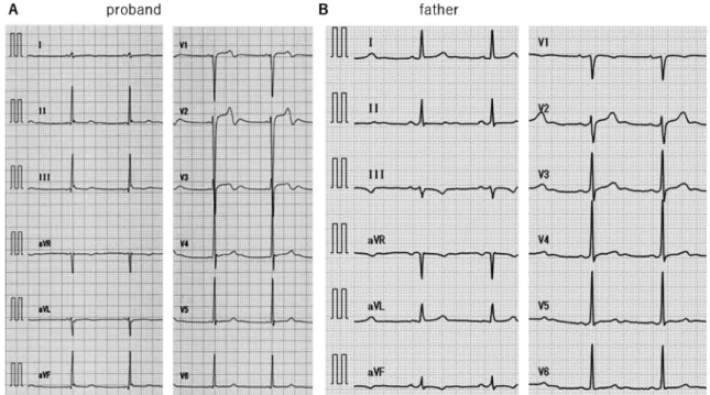 Fig.   3  A: 12-lead ECG immediately after exercise stress test showing functional 2 : 1 atrioventricular block  (AVB)
