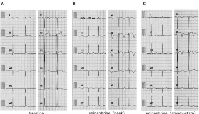 Fig.   6  12-lead ECG at baseline (A), QT: 470, RR: 840, QTc(B): 513, QTc(F): 498 msec, after injection of pro- pro-pranolol (B), QT: 470, RR1000, QTc(B): 470, QTc(F): 470 msec, and additional epinephrine injection  after propranolol, QT: 510, RR1300, QTc(