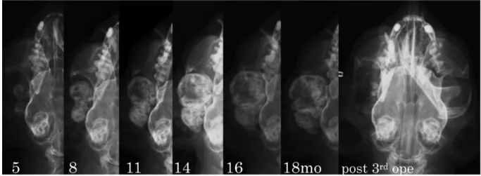 Fig. 5.  The radiological changes of the lesion size over time from 5 months after first surgery to the third surgery.