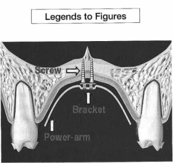 Figure  1.  The  Mid-Palatal  Absolute  Anchorage  System  (MAAS).