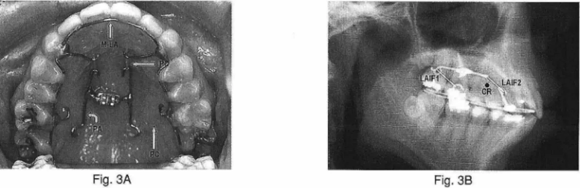 Figure  3.  MAAS for postero-superior  movement  of the  maxillary  dentition.