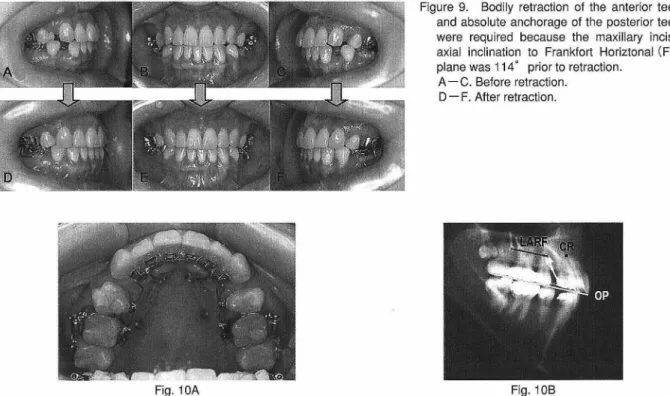 Figure  9.  Bodily  retraction  of  the  anterior  teeth  and  absolute  anchorage  of  the  posterior  teeth