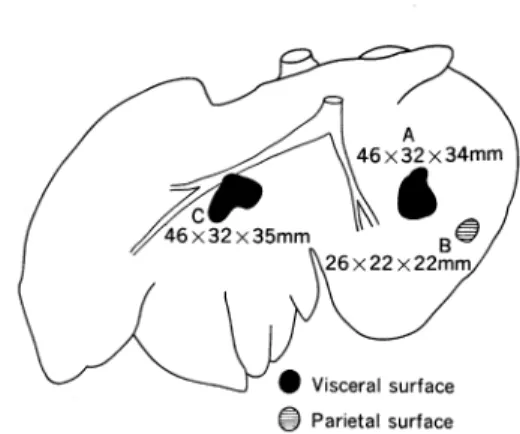 Fig.  1.  Sites  and  sizes  of hepatic  hydatid  cysts  (A, 6  and  C)
