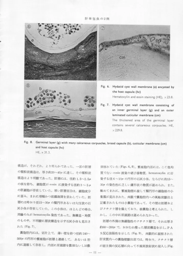 Fig.  6.  Hydatid  cyst  wall  membrane  (e)  encysted  by  the  host  capsule  (hc) 
