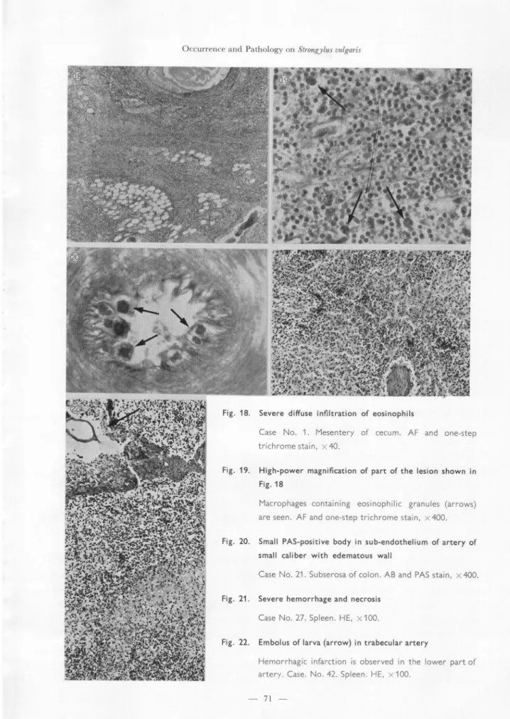 Fig.  18.  Severe  diffuse  infiltration  of  eosinophils