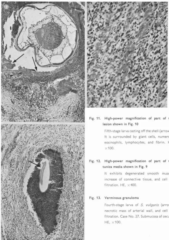 Fig.  11.  High-power  magnification  of  part  of  the  lesion  shown  in  Fig. 10