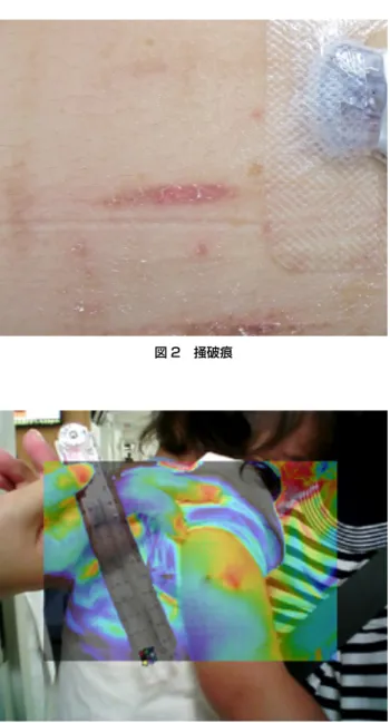 図 2 掻破痕 図 3 右上腕部掻破痕のサーモグラフィ画像 表 2 かぶれの有無による角質水分量の比較かぶれ有群（n＝11） かぶれ無群（n＝20） p 値角質水分量19.9±8.834.2±11.90.002 ＊t-test，mean±SD, ＊p＜0.05 傷（図 1）とインスリンポンプを固定するテープによるかぶ れに伴う掻破痕（いわゆる，ひっかき傷） （図 2）であった． 傷の面積の測定値は表 1 のとおりであった．また，針刺し 傷のみの面積の平均値は 1.06±0.82 mm 2 であった． 4．皮