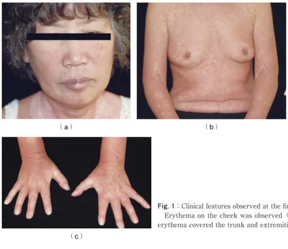 Fig. 1：Clinical features observed at the first visit Erythema on the cheek was observed（a）.Diffuse erythema covered the trunk and extremities（b, c）.