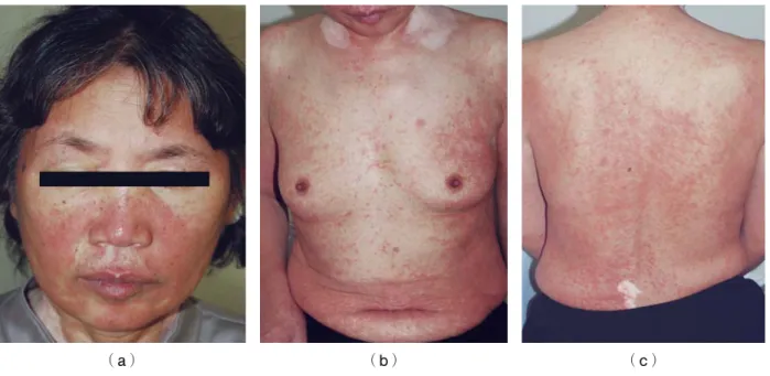Fig. 4：Clinical features observed at recurrence