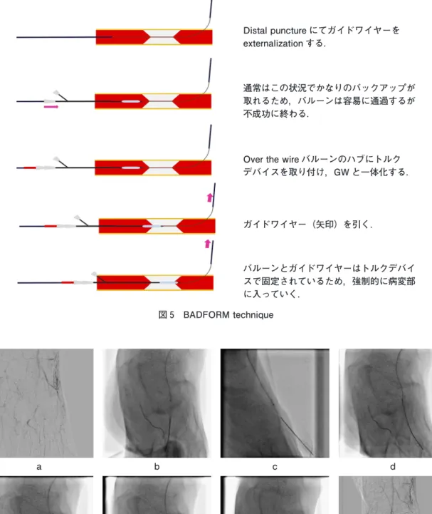 図 6 Needle cracking technique ａ：足背動脈の慢性完全閉塞を認める． ｂ：ガイドワイヤーの通過には成功したが，その後何のデバイスも通らないため，針にて石灰化を壊すこととした． 正面で方向を定めている． ｃ：そのまま側面にして深さも調整した． ｄ：トルナスの先端に向かって穿刺を行い，血管外から血管内の石灰化に亀裂を形成した． ｅ，ｆ：トルナスが少しずつ進み，これを数回繰り返した． ｇ：最終的にトルナスが通過し，バルーニングを行うことが可能となった． ｈ：足背動脈の再疎通に成功した．