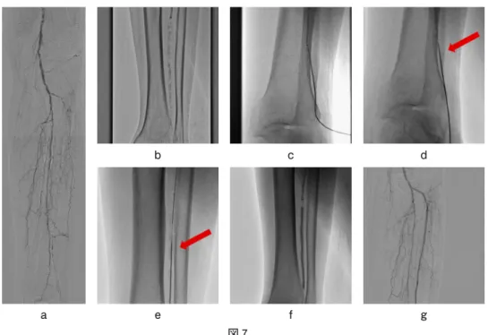 図 7 ａ：左前脛骨動脈の完全閉塞を認める．