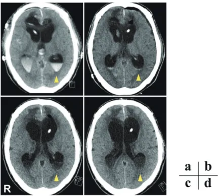 Fig. 2  Chronological CT scans obtained at days 1  ( a ) , 16  ( b ) , 37  ( c ) , and 43  ( d )  post ‒ surgery.