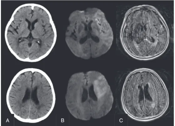 Fig. 1  搬送時の頭部単純 CT （A），MRI 拡散強調像（B），FLAIR 画像（C）