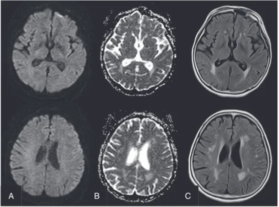 Fig. 3  再開通から 6 時間後の MRI 画像（A） DWI，（B） ADC，（C） FLAIR