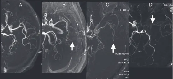 Fig. 2  Degree of visualization of the ipsilateral MCA on brain magnetic resonance angio- angio-graphs was graded as follows：all M3 branches of the left MCA could be visualized  to the cortical surface（grade A）；one M3 branch could not be visualized to the 