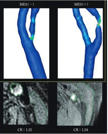 Fig. 8  Relationships among the contrast ratio （CR） ,  WSS, and the development of MES during  carotid exposure in patients with a vulnerable  carotid plaque