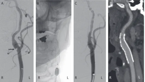 Fig. 6 Carotid web stenting （A–C：全て正面像）と術後 3D-CT angiography 冠状断像（D）