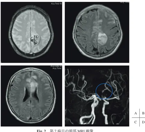 Fig. 2 第 7 病日の頭部 MRI 画像  A  ：T2 ＊ WI で左頭頂葉に低信号域を認めた．