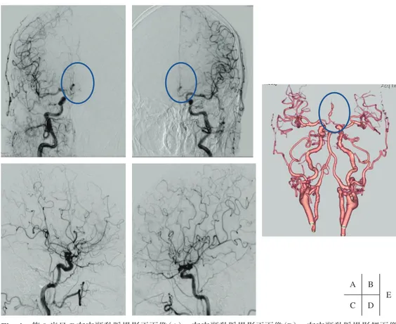 Fig. 4   第 8 病日の右内頸動脈撮影正面像（A），左内頸動脈撮影正面像（B），右内頸動脈撮影側面像