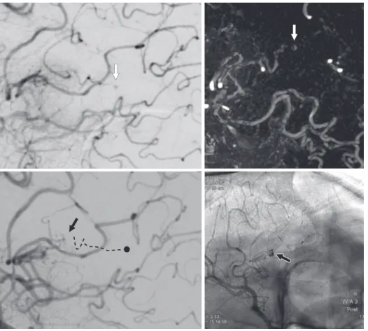 Fig. 3  Intraoperative digital sub- sub-traction angiography (DSA).