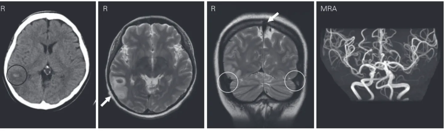 Fig. 2  Computed tomography  (CT) performed after the  coma shows an increase  in the hematoma size and  signs of herniation.