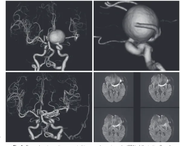 Fig. 1  Pre- and postoperative computed tomography angiography (CTA) of illustrative Case 1.