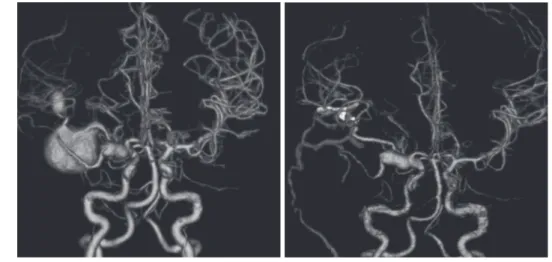 Fig. 2  Pre- and postoperative computed tomography angiography (CTA) of illustrative Case 2.