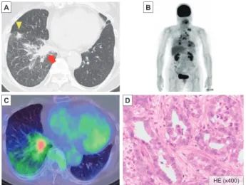 Figure 2. Radiological  CT  images.  (A)  After  3  cycles  of  maintenance  therapy  with  PEM＋BEV.  The  primary   tu-mor  increased  in  size.  (B)  After  drainage  of  right  pleural  effusion. (C) Two months after the initiation of osimertinib,  the 