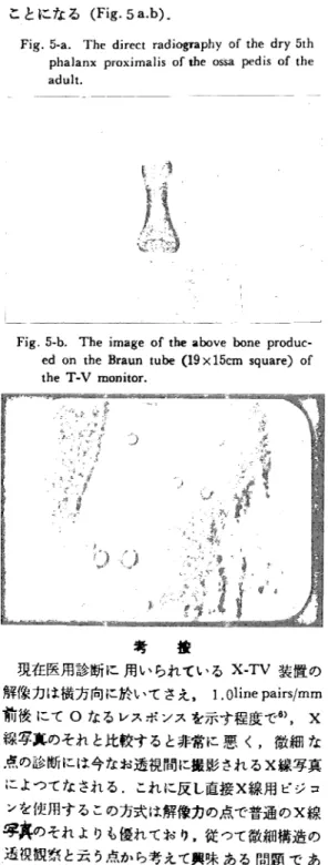 Fig.  5-b.  The  image  of  the  above  bone  produc-     ed  on  the  Braun  tube   (19  x15cm   square)  of 