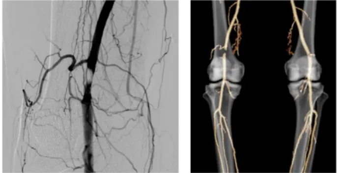 Figure 1  Preoperative angiography (left) and three-dimensional  computed tomography (right) showed right popliteal artery   obstruction above the knee