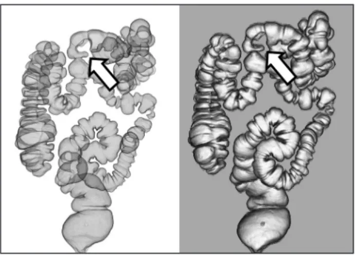 図 3　従来の注腸検査 図 4　大腸 CT 撮影