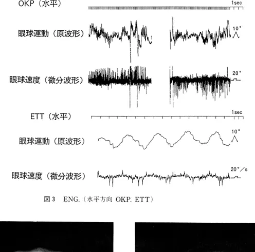 図  4  CT.(単 純) 図 5  MRI.(造 影Gd‑DTPA)